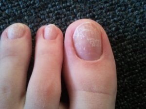 Nail Disease