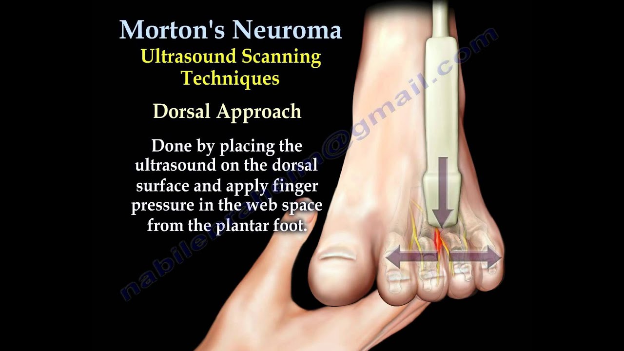 What is Morton’s Neuroma?