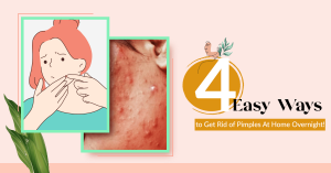 4 Easy Ways to Get Rid of Pimples at Home Overnight