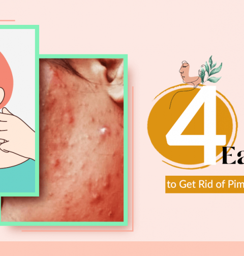 4 Easy Ways to Get Rid of Pimples at Home Overnight