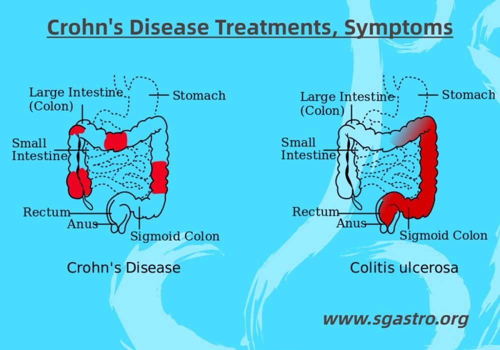 Crohn's Disease Treatments, Symptoms