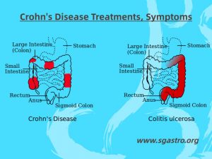 Crohn's Disease Treatments, Symptoms