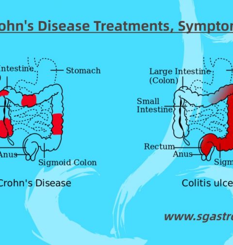Crohn's Disease Treatments, Symptoms