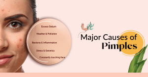 Major Causes of Pimples
