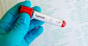Typhoid