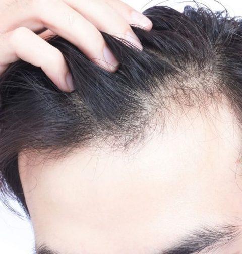 Genetic Hair Loss