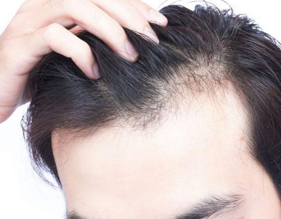Genetic Hair Loss