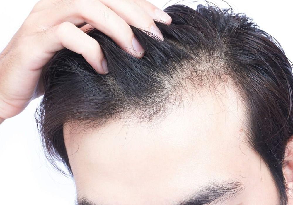 Genetic Hair Loss