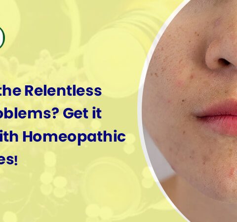 Homeopathic medicines for acne, pimples & acne scars