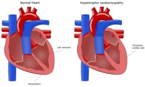 Serious Cardiomyopathy
