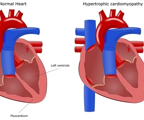 Serious Cardiomyopathy